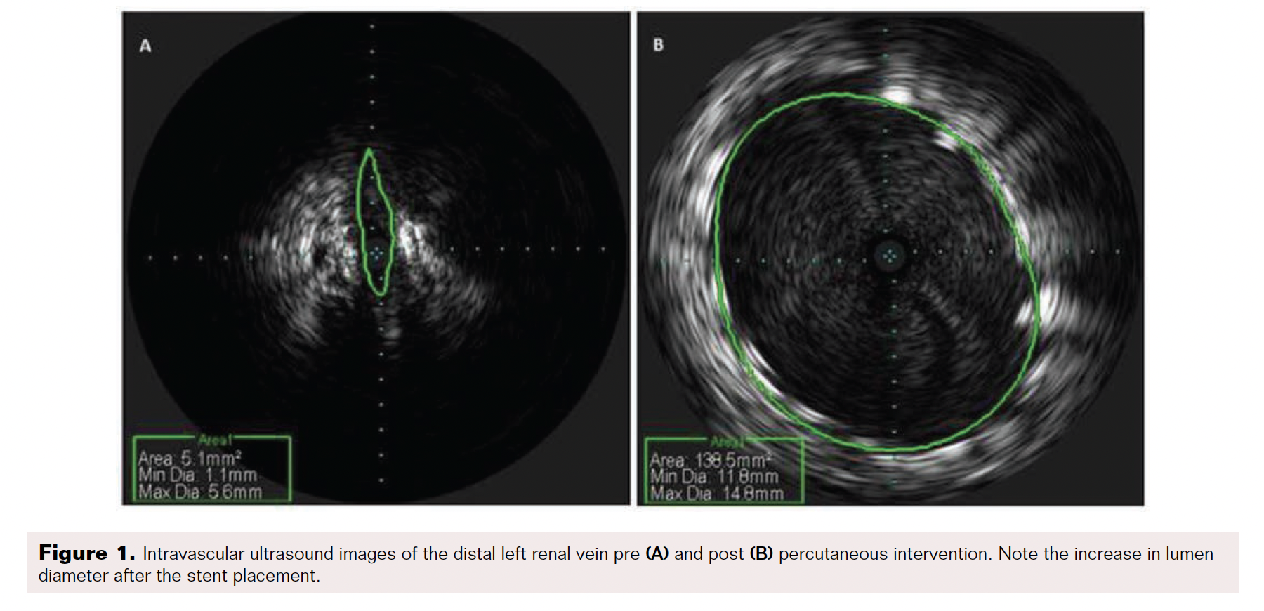 Nutcracker Syndrome A Rare Etiology of PCS VDM